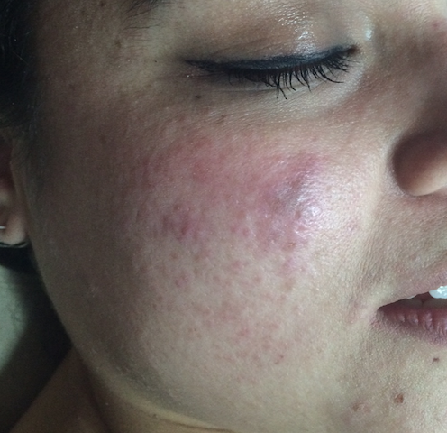 Rosásea Dermatologos Guatemala